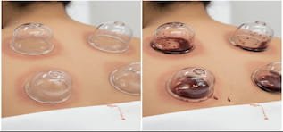 Bekam Kering dan Bekam Basah Hendayani Home Spa